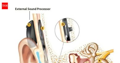 अभिनव कानाची शस्त्रक्रिया 23 वर्षांच्या वृद्धाला एकतर्फी बहिरेपणापासून बरे होण्यास मदत करते